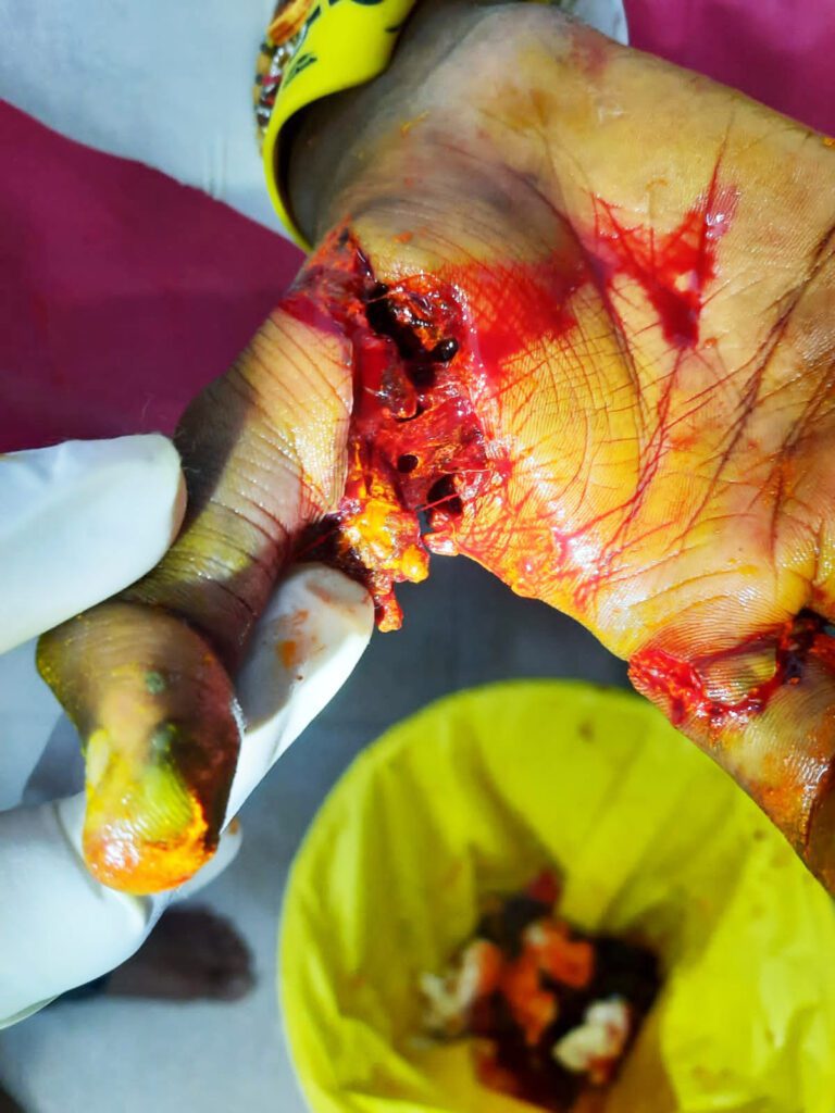 अॅटमबॉम्ब फुटून पंधरा वर्षिय मुलगा जखमी